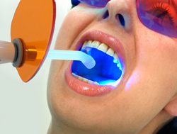 blanqueamiento dental