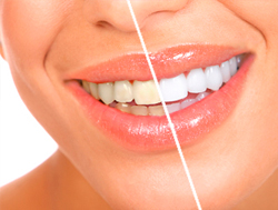 blanqueamiento dental antes y después