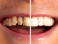 carillas de composite antes y después