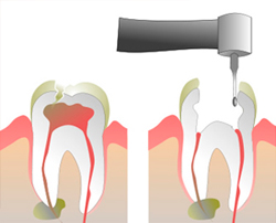 proceso endodoncia
