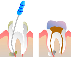 proceso endodoncia
