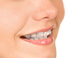 ortodoncia estética