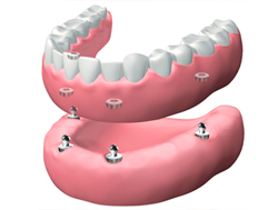 dentadura extraíble