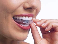  ortodoncia invisalign