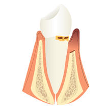 diente con periodoncia inicial
