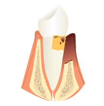 diente con periodoncia moderada