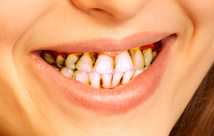 periodoncia severa