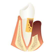 diente con periodoncia severa