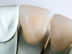 coronas de zirconio
