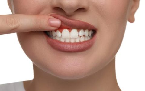 Gingivitis: Cómo prevenir y tratar esta afección para mantener una sonrisa radiante