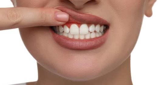 Gingivitis: Cómo prevenir y tratar esta afección para mantener una sonrisa radiante