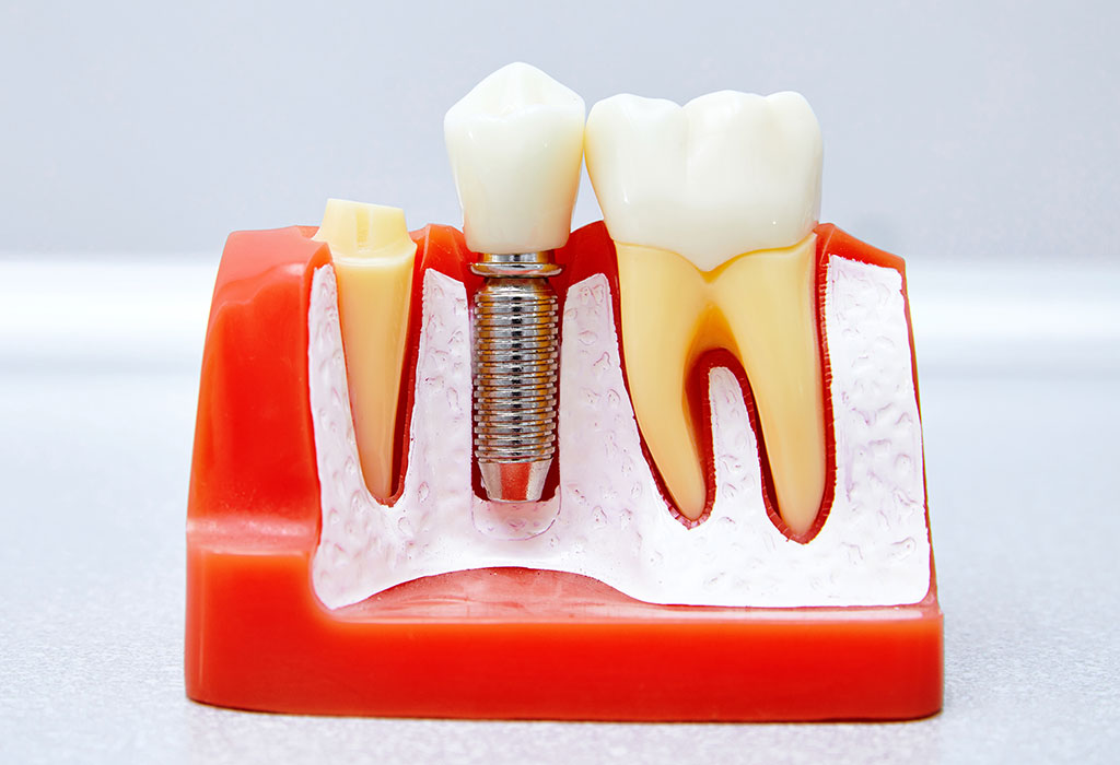 Implantes dentales en Barajas (Madrid)