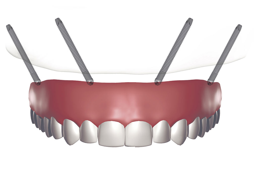 Implantes dentales en Barajas (Madrid)
