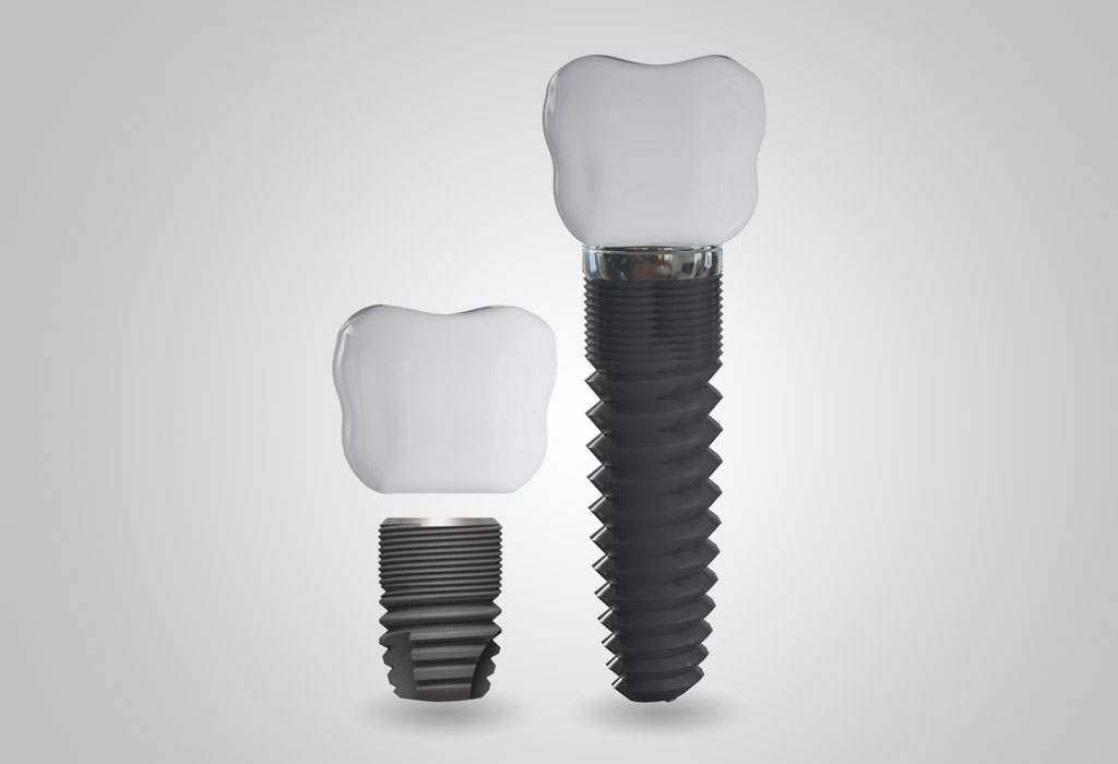 Implantes dentales en Barajas (Madrid)