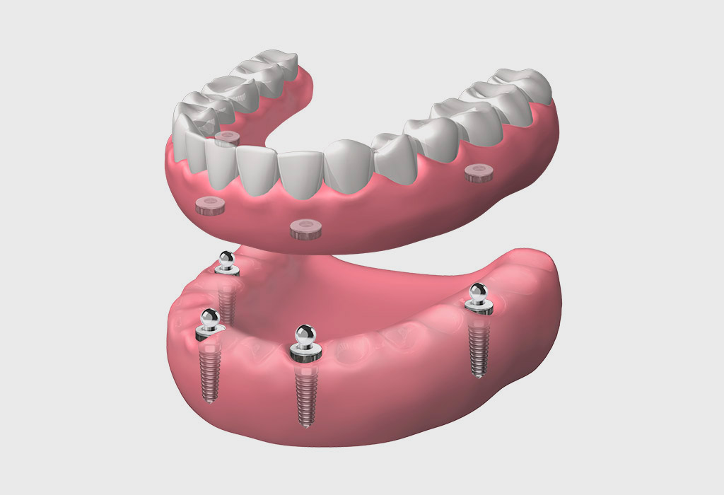 Implantes dentales en Barajas (Madrid)