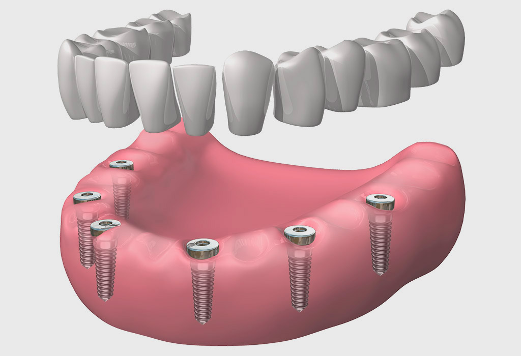 Implantes dentales en Barajas (Madrid)