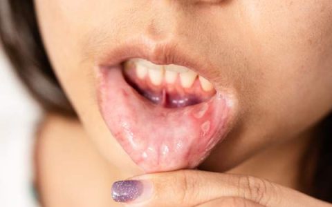 Llagas en la boca falta de vitamina: cómo prevenir y tratar el problema