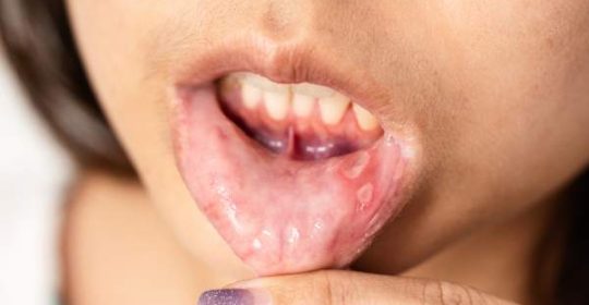 Llagas en la boca falta de vitamina: cómo prevenir y tratar el problema