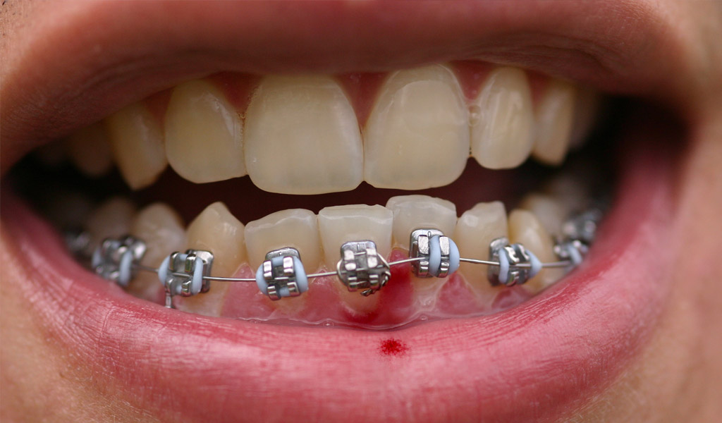 Urgencias dentales por ortodoncia