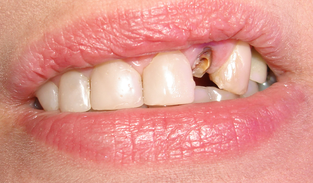 Urgencias dentales por pérdida